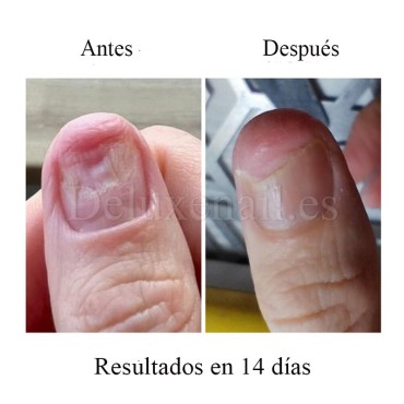 Onistop Podology+ NAILSOFTHEDAY, Tratamiento para prevenir y curar el hongo y la onicólisis de las uñas, 15 ml