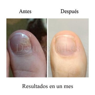 Onistop Podology+ NAILSOFTHEDAY, Tratamiento para prevenir y curar el hongo y la onicólisis de las uñas, 15 ml