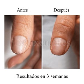 Onistop Podology+ NAILSOFTHEDAY, Tratamiento para prevenir y curar el hongo y la onicólisis de las uñas, 15 ml