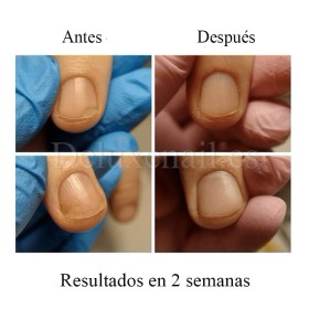 Onistop Podology+ NAILSOFTHEDAY, Tratamiento para prevenir y curar el hongo y la onicólisis de las uñas, 15 ml