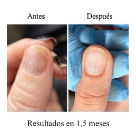 Onistop Podology+ NAILSOFTHEDAY, Tratamiento para prevenir y curar el hongo y la onicólisis de las uñas, 15 ml