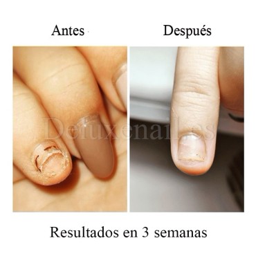 Onistop Podology+ NAILSOFTHEDAY, Tratamiento para prevenir y curar el hongo y la onicólisis de las uñas, 15 ml