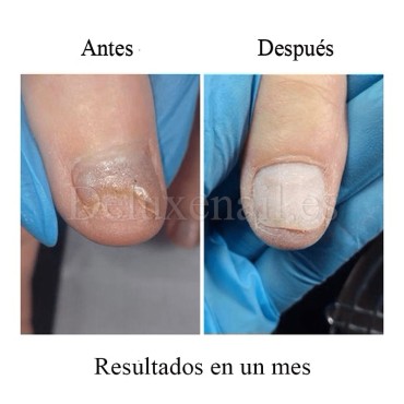Onistop Podology+ NAILSOFTHEDAY, Tratamiento para prevenir y curar el hongo y la onicólisis de las uñas, 15 ml